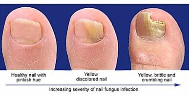 La manifestation des champignons à ongles