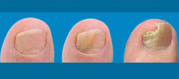 Étapes du champignon de l'ongle
