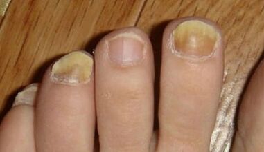 Les causes de l'apparence du champignon sur les ongles