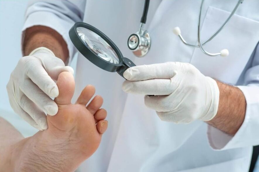 le docteur examine les ongles pour le champignon