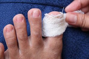 Un ongle malade