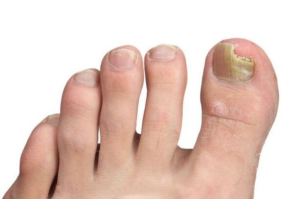 Causes de champignons à ongles