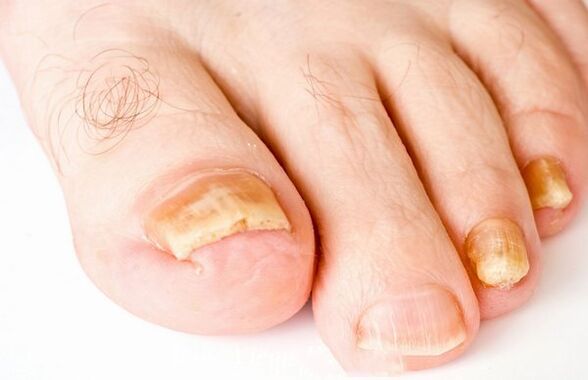 Formes de champignons à ongles