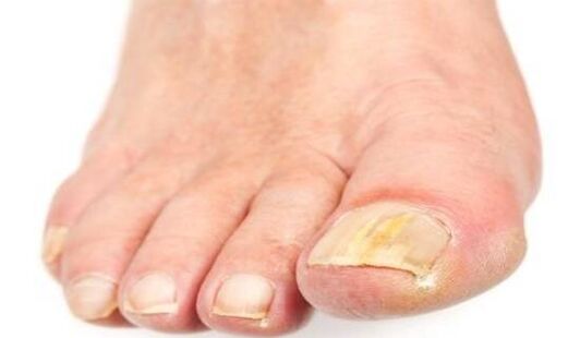 jaunissement des ongles dû à une infection fongique