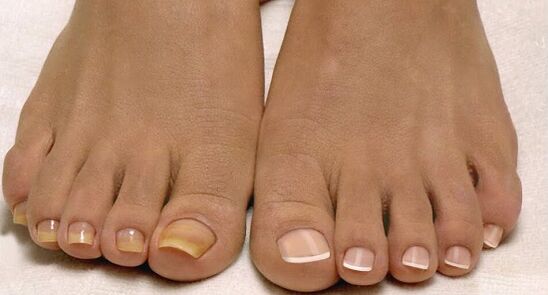 ongles normaux et mycose des ongles des pieds