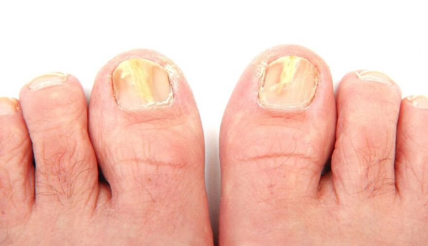 champignon sur les ongles