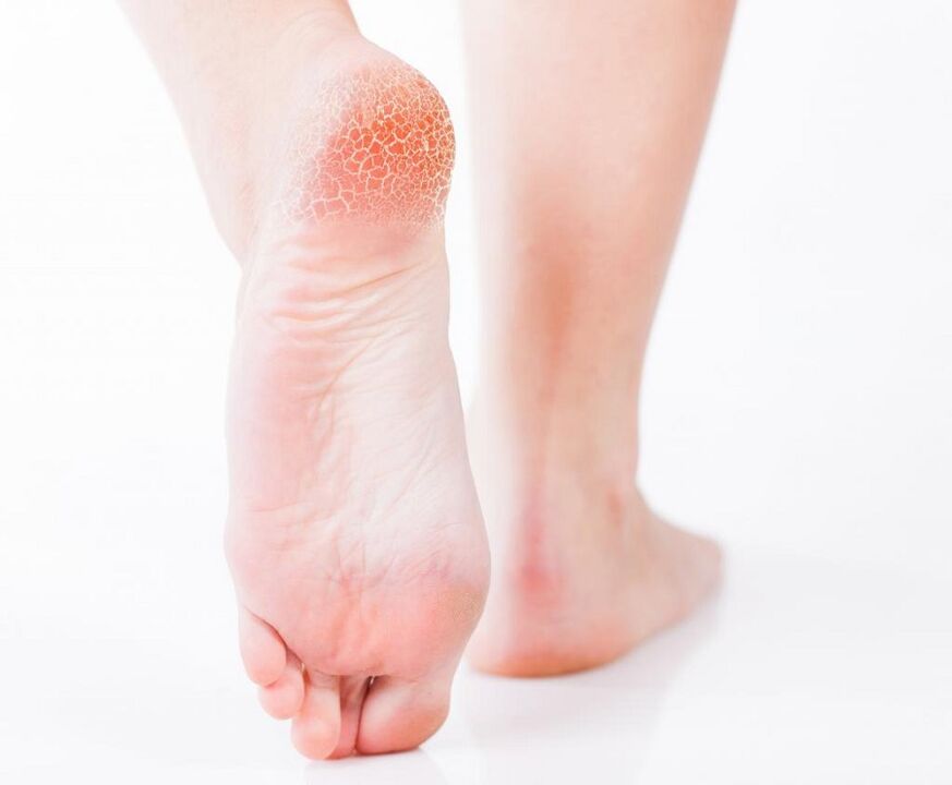 infection fongique sur le pied