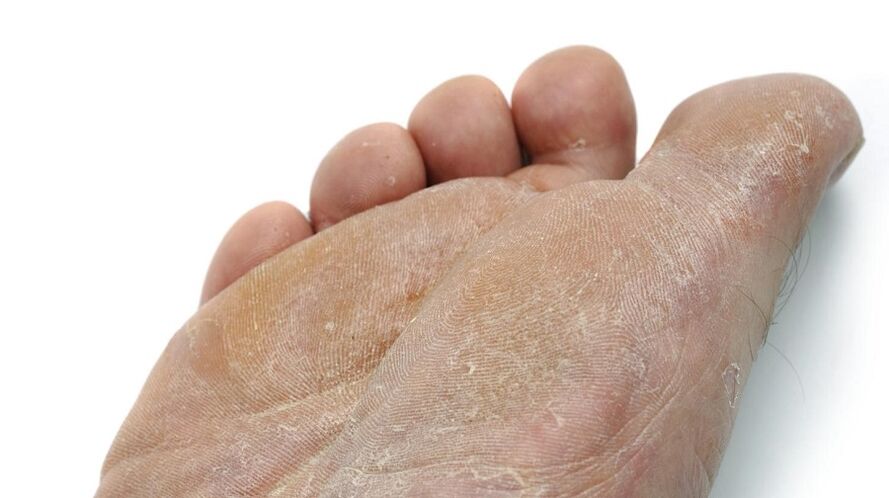 symptômes de champignon du pied