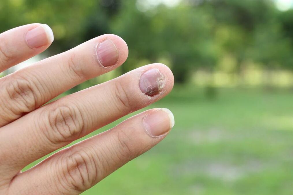 champignon des ongles