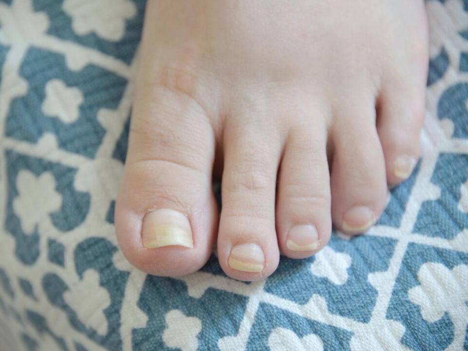 champignon sur les ongles