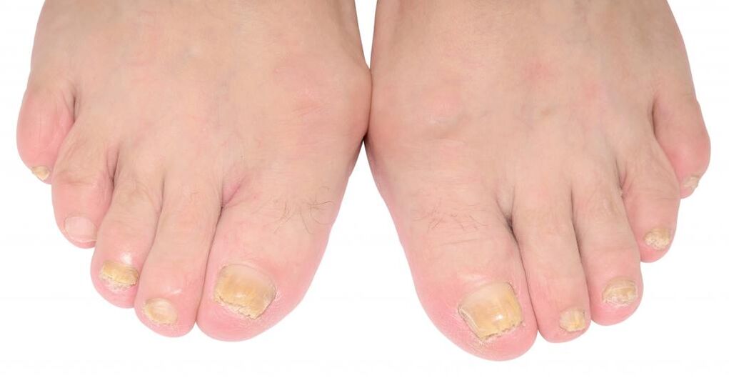 signes de mycose des ongles