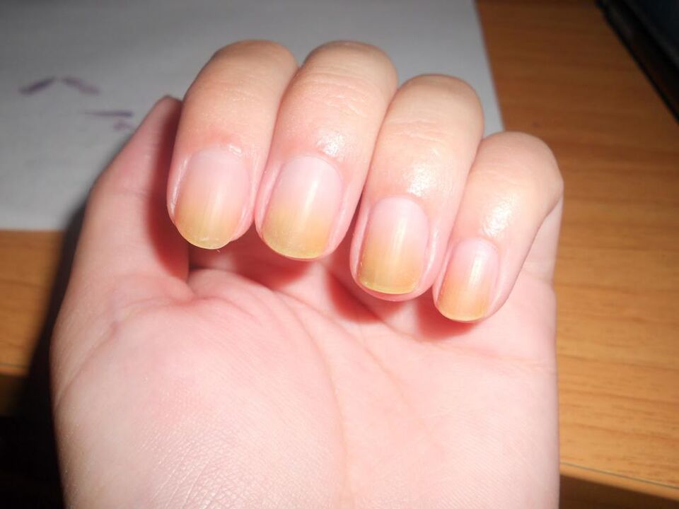 symptômes de mycose des ongles
