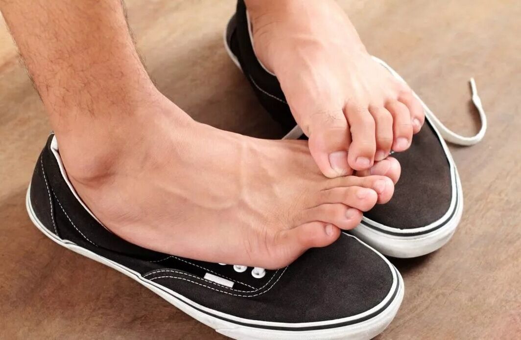 démangeaisons dans les pieds dues à un champignon entre les orteils