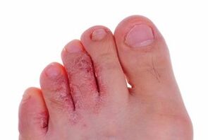 lésions cutanées dues à des champignons sur les jambes