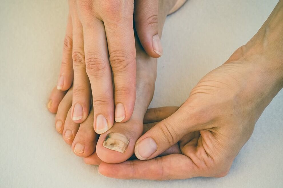 Dommages à la plaque à ongles avec des champignons