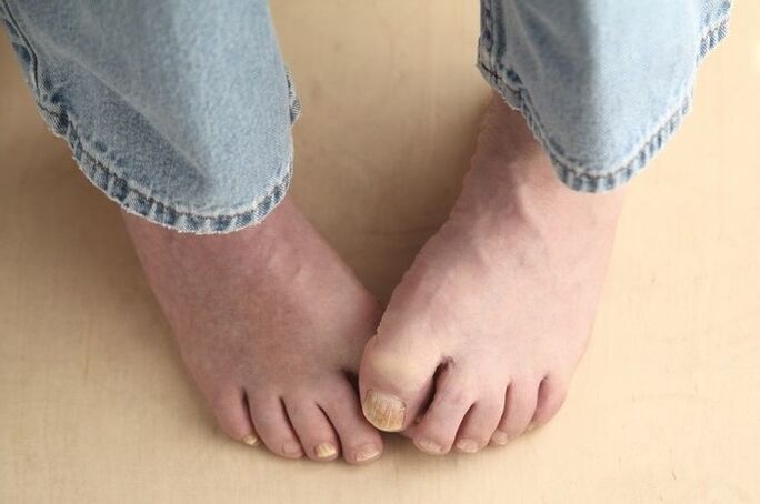 Pieds avec des ongles affectés par des champignons