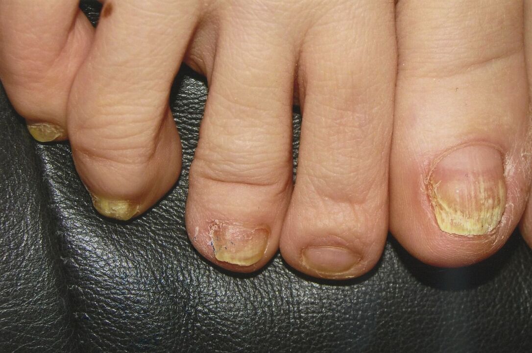 Champignon sur les ongles